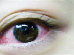 秋季这2大眼病高发,多补水,重卫生,做好预防!